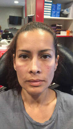 filler patient after