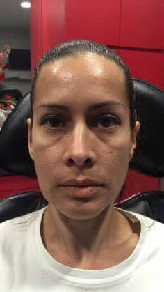 filler patient before