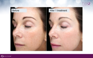 halo bbl before after