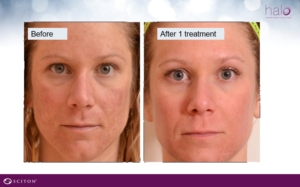 halo bbl before after