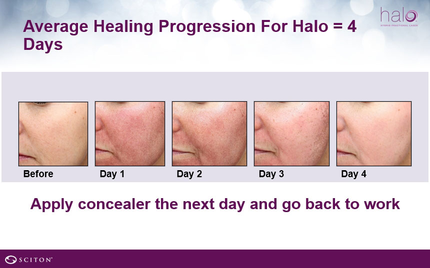 halo bbl before after treatment