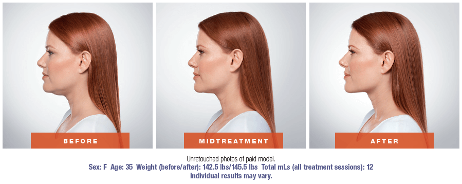 kybella patient before and after