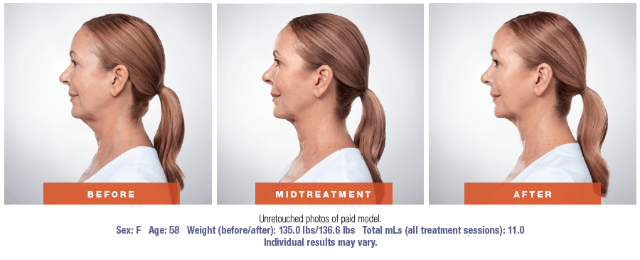 kybella patient before and after