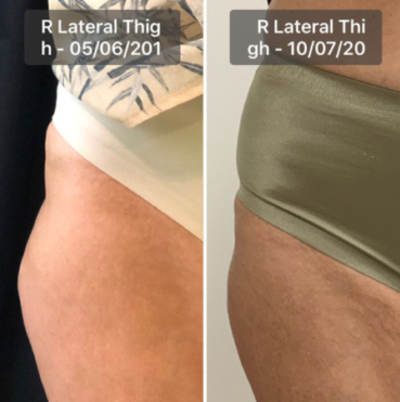 trusculpt patient before and after