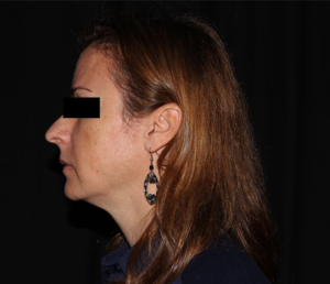 after vi peel