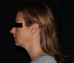 before vi peel