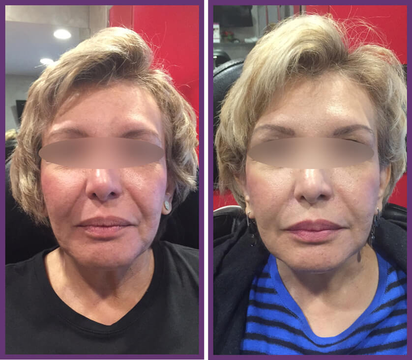 Juvederm Results