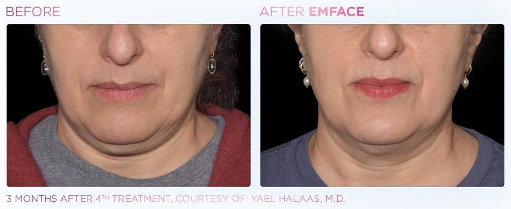 EMFACE before and after of chin from the front