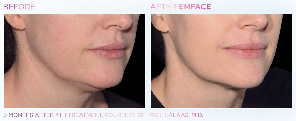 EMFACE before and after photos of jawline from the side