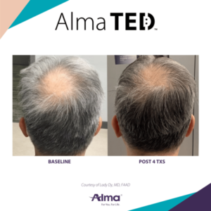 Patient before and after Alma TED treatment