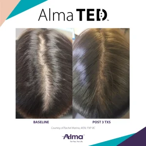 Patient before and after Alma TED treatment