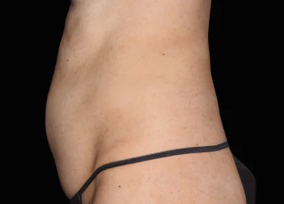 Before emsculpt