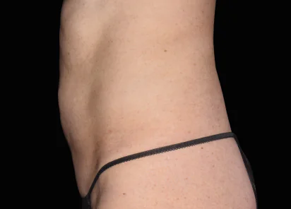 After emsculpt