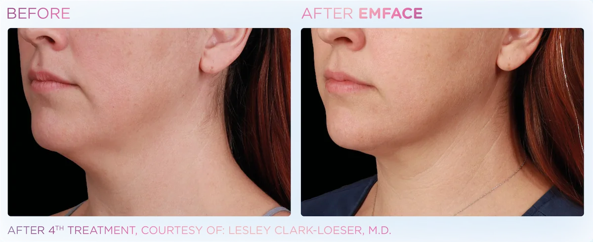 Patient results emface submentum